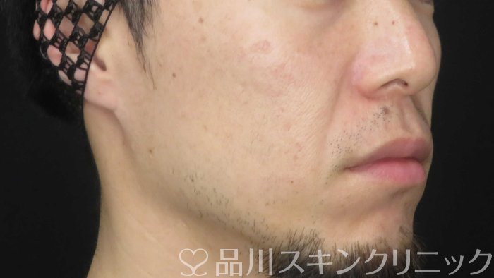 症例NO.70913のAFTER写真