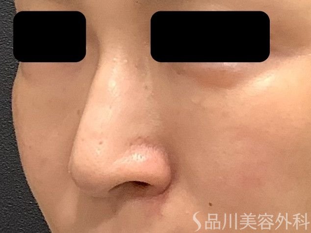 症例NO.75322のBEFORE写真
