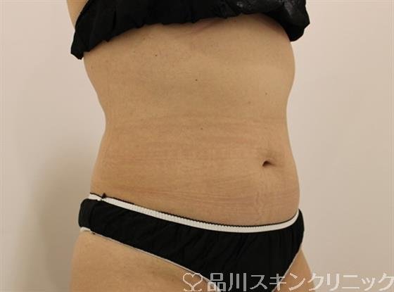 症例NO.48166のAFTER写真