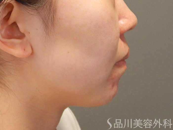 症例NO.70852のBEFORE写真
