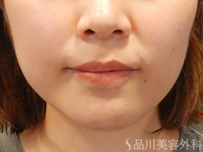 症例NO.70714のBEFORE写真