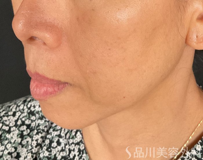 症例NO.74976のBEFORE写真