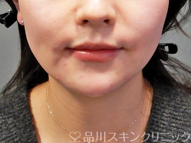 症例NO.68183のAFTER写真