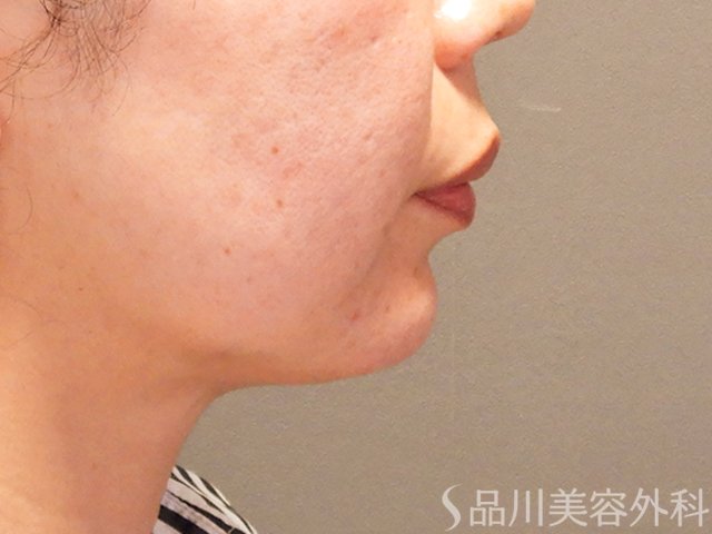 症例NO.69577のAFTER写真