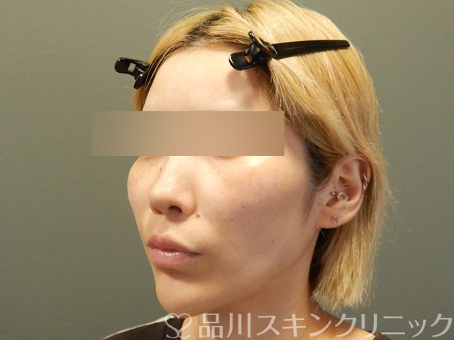 症例NO.65754のBEFORE写真