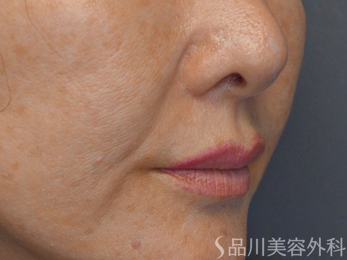 症例NO.69309のBEFORE写真