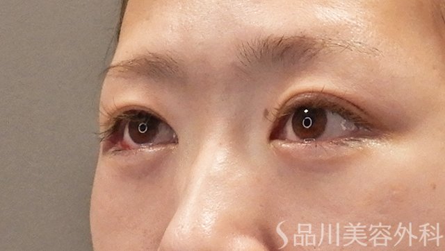 症例NO.73798のAFTER写真