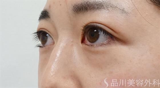 症例NO.50762のBEFORE写真