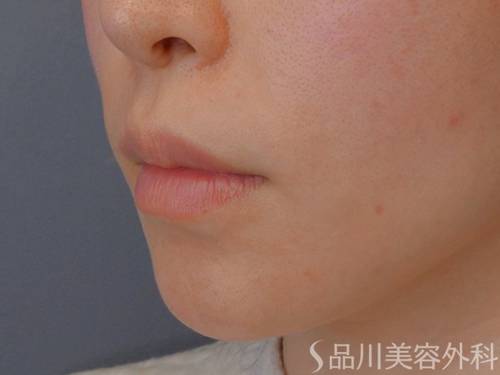 症例NO.73989のBEFORE写真