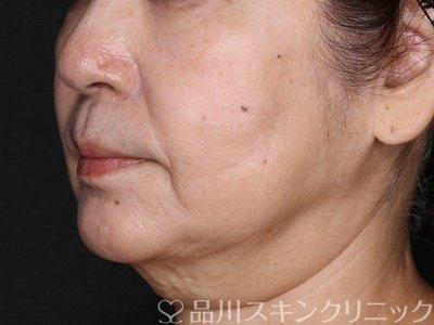 症例NO.72891のAFTER写真