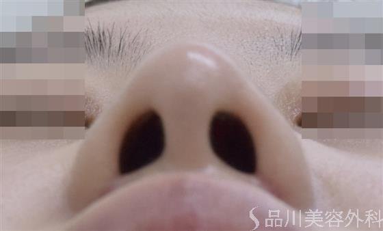 症例NO.46734のAFTER写真