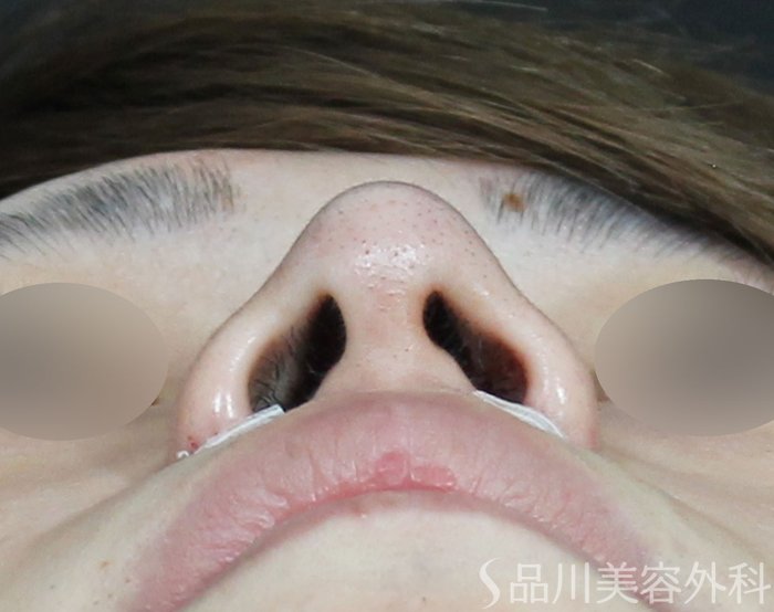 症例NO.71295のAFTER写真