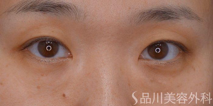 症例NO.74130のBEFORE写真