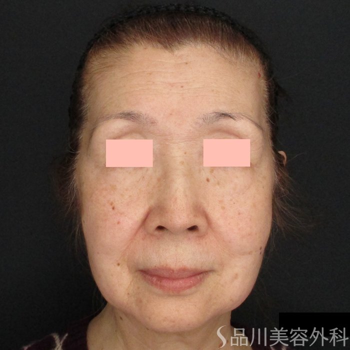 症例NO.73026のBEFORE写真