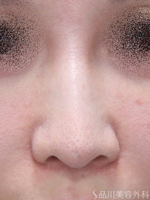 症例NO.74730のBEFORE写真