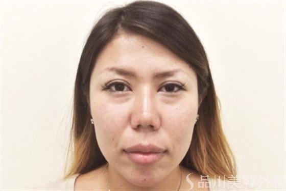 症例NO.18613のAFTER写真
