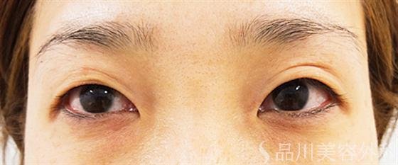 症例NO.17624のBEFORE写真