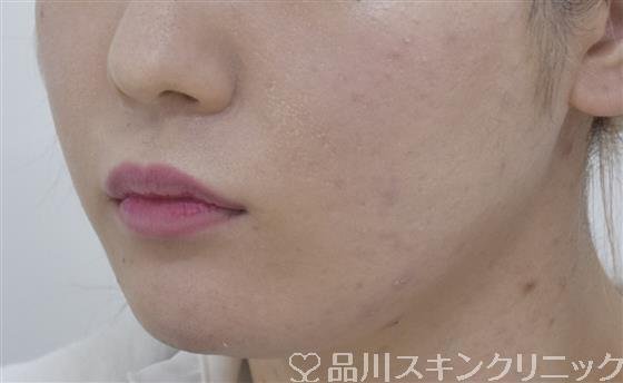 症例NO.53434のAFTER写真