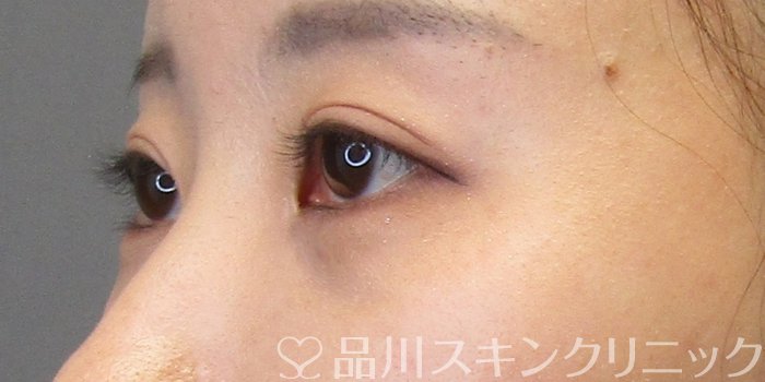 症例NO.75157のBEFORE写真