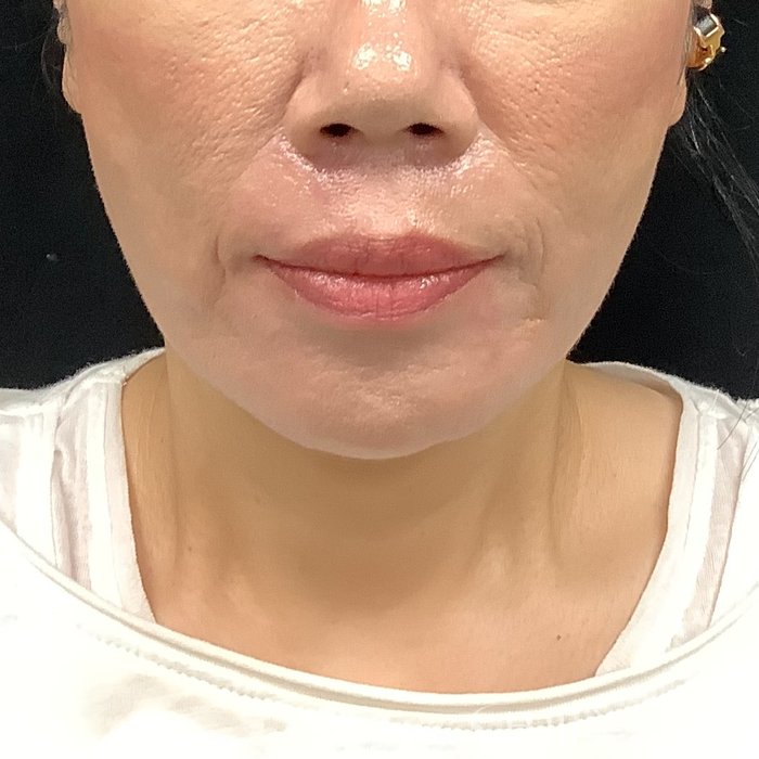 症例NO.75349のAFTER写真
