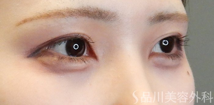症例NO.65100のAFTER写真