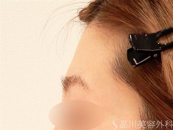 症例NO.59839のBEFORE写真