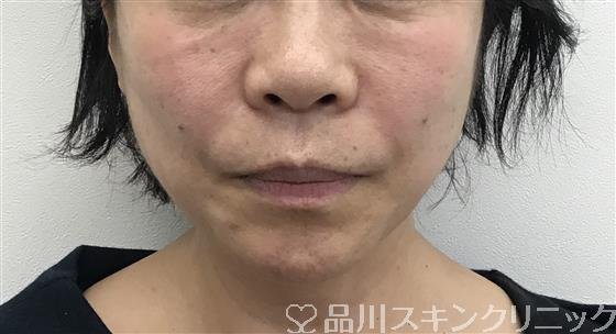 症例NO.47013のAFTER写真