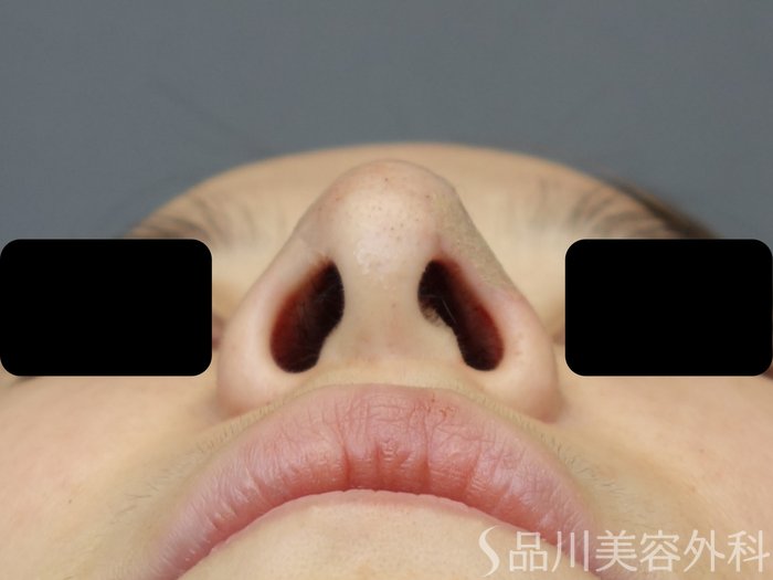 症例NO.71591のAFTER写真