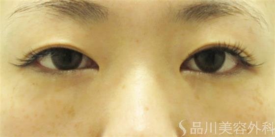 症例NO.42046のBEFORE写真