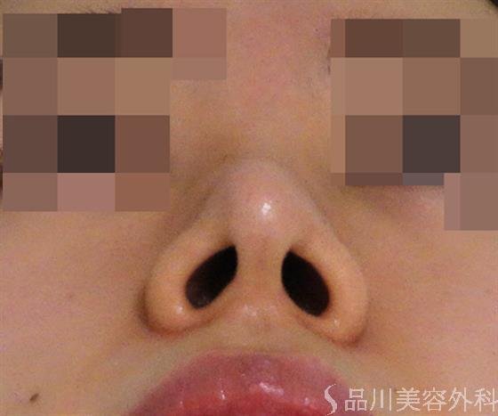 症例NO.47081のAFTER写真