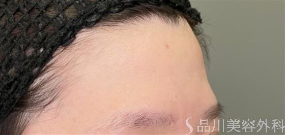 症例NO.50543のBEFORE写真