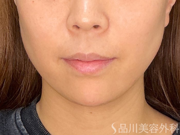 症例NO.72621のAFTER写真