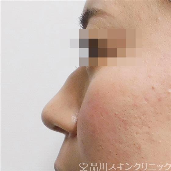 症例NO.55378のAFTER写真