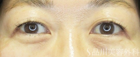 症例NO.69418のBEFORE写真