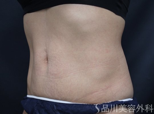 症例NO.75189のAFTER写真
