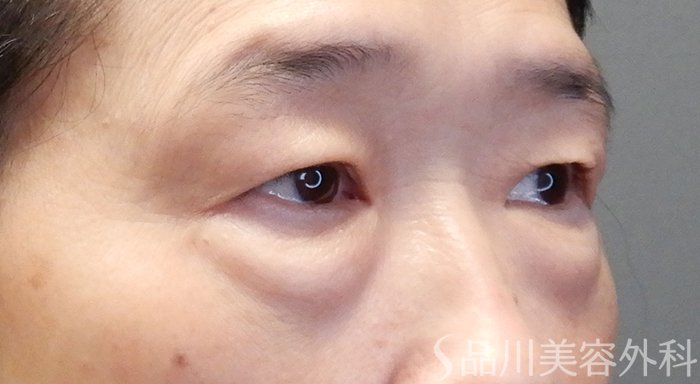 症例NO.70528のBEFORE写真