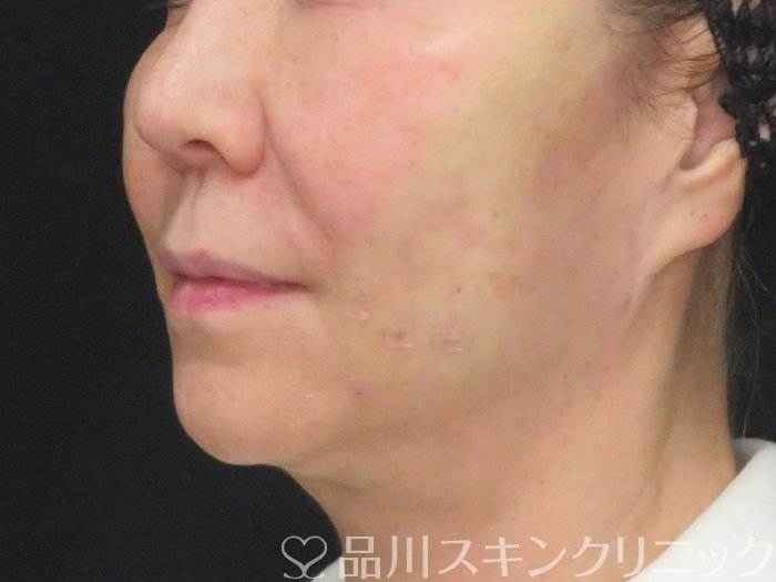 症例NO.73162のAFTER写真