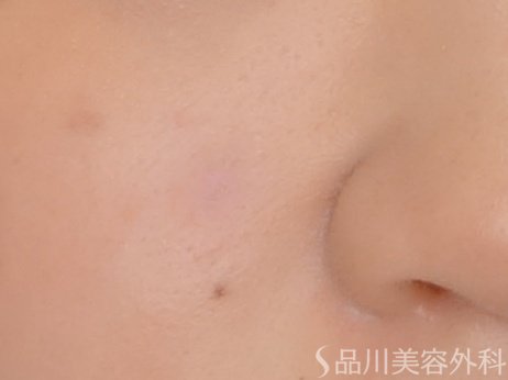 症例NO.70102のAFTER写真