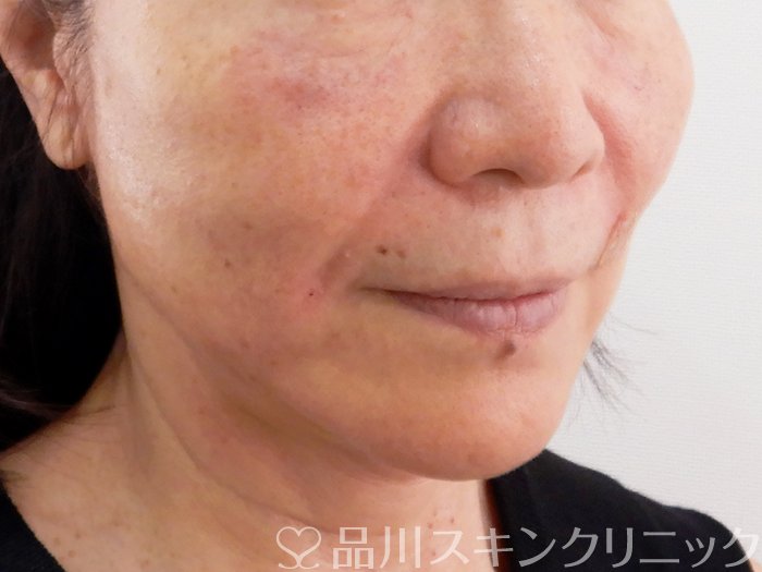 症例NO.62544のAFTER写真