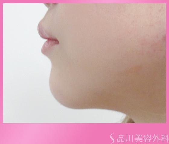 症例NO.1794のAFTER写真