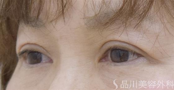 症例NO.51078のAFTER写真
