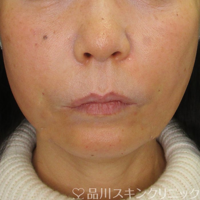 症例NO.73579のAFTER写真