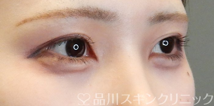 症例NO.65100のAFTER写真