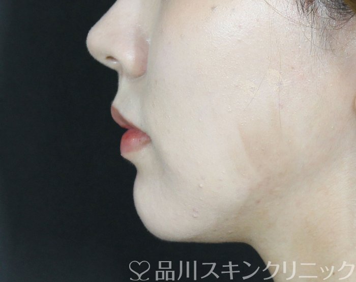 症例NO.69835のBEFORE写真