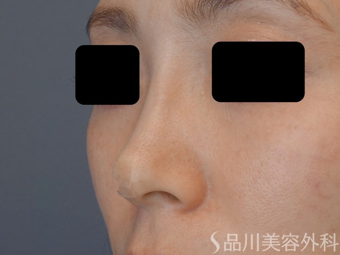 症例NO.72407のAFTER写真