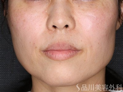症例NO.74325のBEFORE写真