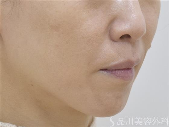 症例NO.51124のAFTER写真
