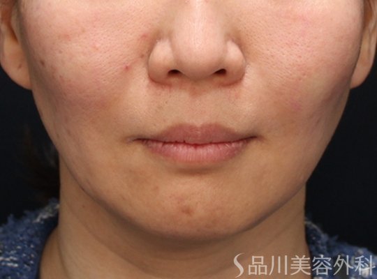 症例NO.73333のAFTER写真