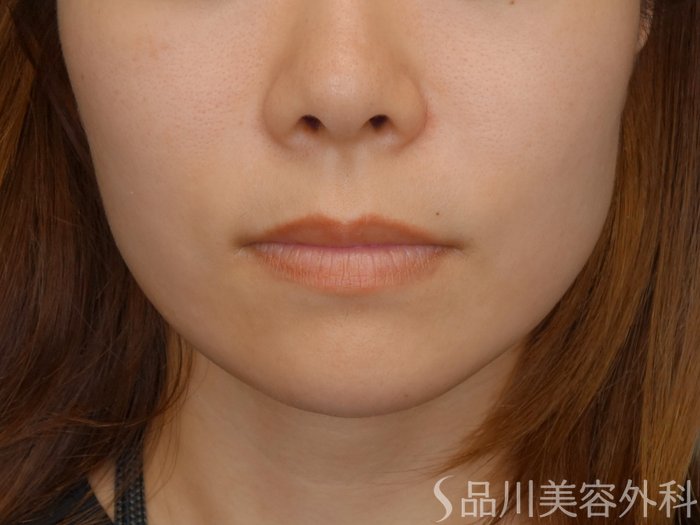 症例NO.70803のBEFORE写真