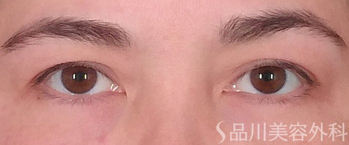 症例NO.69352のBEFORE写真